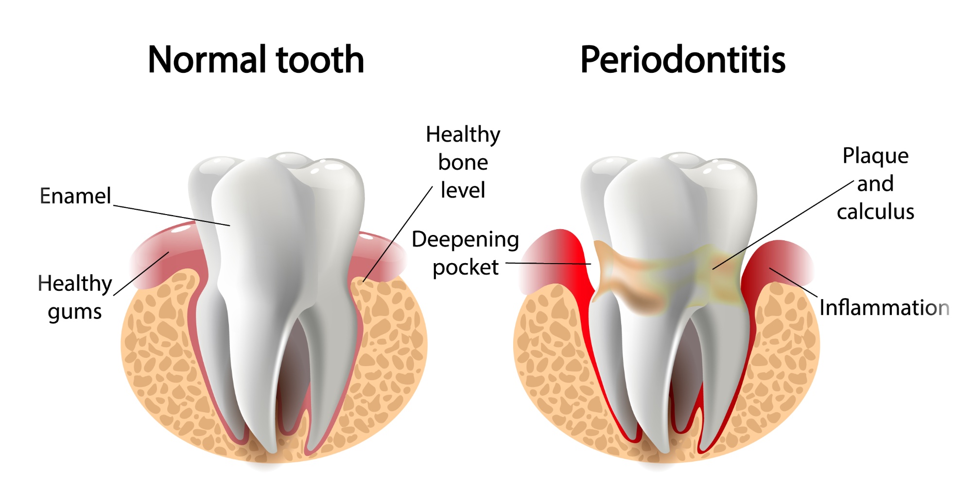 歯周病治療 イメージ画像
